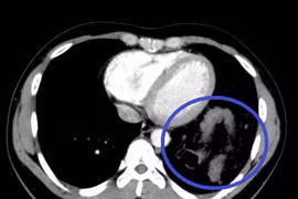 Tưởng hậu Covid-19, bệnh nhân đến viện khám mới biết bị vỡ cơ hoành