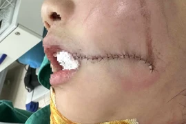 Liên tục cấp cứu người lớn, trẻ em vỡ xương hàm, gãy răng do tai nạn thang máy