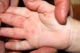 Số mắc tay chân miệng trên cả nước tăng hơn 4 lần, Hà Nội ghi nhận hơn 80 ca