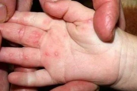 Số mắc tay chân miệng trên cả nước tăng hơn 4 lần, Hà Nội ghi nhận hơn 80 ca