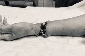 Nữ bệnh nhân 74 tuổi tự cắt đứt lìa cổ bàn tay trái, được cấp cứu và nối tay kịp thời