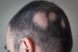 Thấy tóc rụng nhiều bất thường, nam thanh niên đi khám phát hiện mắc… giang mai