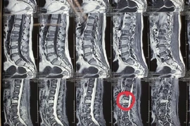 Nhiều bệnh nhân bị lún, xẹp đốt sống được điều trị hiệu quả bằng... bơm xi măng 