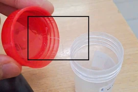 Hiếm gặp: Phát hiện ký sinh trùng trong mắt của một bệnh nhân