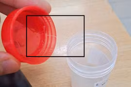 Hiếm gặp: Phát hiện ký sinh trùng trong mắt của một bệnh nhân