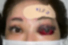 Cô gái trẻ bị mù một mắt do tự ý tiêm filler nâng mũi tại nhà