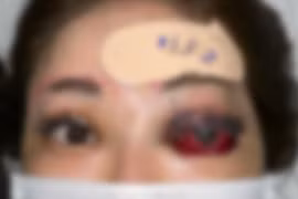 Cô gái trẻ bị mù một mắt do tự ý tiêm filler nâng mũi tại nhà