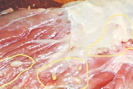 Hay ăn thịt bò tái, rau sống, một phụ nữ ở Hà Nội nhập viện vì mắc sán dây