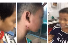Một trong hai bệnh nhi mắc whitmore điều trị tại Bệnh viện Nhi Trung ương tử vong