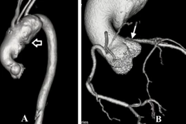 Hy hữu: Bệnh nhân phình động mạch chủ cực đại tới nửa gang tay, được cứu sống thần kỳ