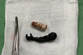 Gắp ra cánh tay đồ chơi siêu nhân bằng nhựa, đầu bút từ âm đạo bé 5 tuổi