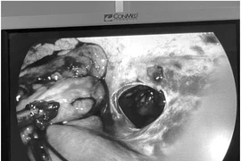 Một phụ nữ ở quận Long Biên bị thương nặng do dao đâm thấu bụng được cứu sống kịp thời