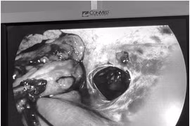 Một phụ nữ ở quận Long Biên bị thương nặng do dao đâm thấu bụng được cứu sống kịp thời