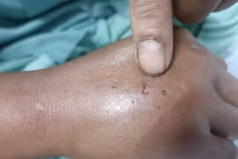 Truyền 10 lọ huyết thanh cứu hai chị em sinh đôi bị rắn hổ mang cắn