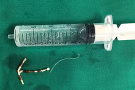 Hiếm gặp: Vòng tránh thai hình chữ T đi lạc vào trong bàng quang