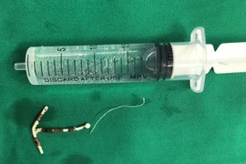 Hiếm gặp: Vòng tránh thai hình chữ T đi lạc vào trong bàng quang