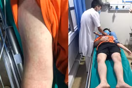 Nam thanh niên sốc phản vệ nguy kịch vì bắt con mối để nấu ăn