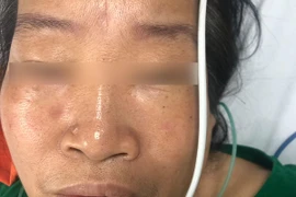 Bị ong lạ đốt, nữ bệnh nhân ở Hà Nội nhồi máu cơ tim cấp, ngừng tuần hoàn