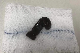 Bác sĩ giật mình khi nội soi nhìn rõ con đỉa lớn đang di chuyển trong mũi bệnh nhân