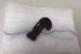 Bác sĩ giật mình khi nội soi nhìn rõ con đỉa lớn đang di chuyển trong mũi bệnh nhân