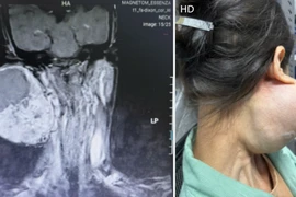 Người phụ nữ suýt mất mạng vì đeo khối u khổng lồ trên mặt suốt 14 năm