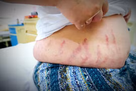 Dùng quá nhiều thuốc xịt mũi, 2 anh em trai mắc hội chứng rậm lông, đỏ da, phù chân…