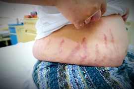 Dùng quá nhiều thuốc xịt mũi, 2 anh em trai mắc hội chứng rậm lông, đỏ da, phù chân…