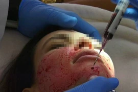 Cơn “sốt” làm đẹp da bằng… máu tự thân, coi chừng tiền mất tật mang