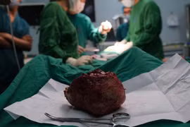 Cắt bỏ bướu giáp khổng lồ cho cụ bà 92 tuổi ở Hà Nội