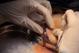 Cô gái bị áp xe, hoại tử má do tiêm filler thường xuyên để làm căng bóng da mặt