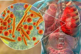 Bộ Y tế thông tin về các trường hợp mắc bệnh “lạ” tại Nga: Việt Nam chưa ghi nhận bệnh nhân