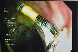 Người phụ nữ 38 tuổi nhập viện vì vòng tránh thai đâm xuyên thành tử cung