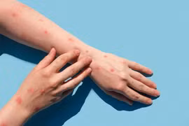 Đồng Nai ghi nhận ca đậu mùa khỉ đầu tiên, chưa xác định được nguồn lây