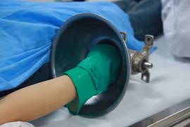 Người phụ nữ nhập viện với bàn tay vẫn mắc kẹt trong máy xay thịt