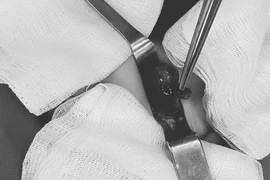 Bố mẹ đi làm xa, bé trai phải cắt bỏ tinh hoàn bị xoắn hoại tử do tới bệnh viện muộn