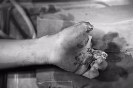 Pin quạt tích điện phát nổ, cháu bé dập nát bàn tay, cụt 3 ngón