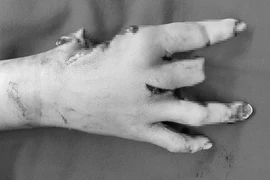 Tự chế pháo nổ để chơi Tết, bé trai 12 tuổi nhập viện với bàn tay dập nát