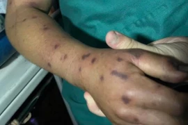 Bị sốc phản vệ độ 3 do ong đốt, người đàn ông được bác sĩ Long Châu cứu nguy trong gang tấc