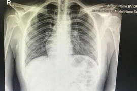 Hy hữu: Nam thanh niên Hà Nội có phủ tạng đảo ngược hoàn toàn, tim nằm bên phải