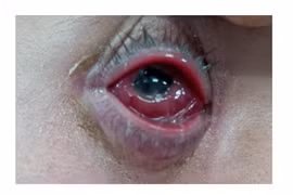 Nam thanh niên sưng mắt, mưng mủ phù nề chữa mãi không khỏi, hóa ra bị… bệnh đường tình dục