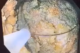 Nữ bệnh nhân ở Hà Nội tắc ruột vì ăn 5 quả hồng ngâm