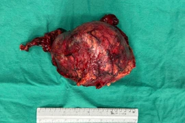 Người phụ nữ bất ngờ phát hiện có khối u thận khổng lồ