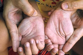 Thời tiết nồm ẩm, số mắc tay chân miệng tại Hà Nội tăng gần 1,4 lần trong tuần