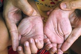 Thời tiết nồm ẩm, số mắc tay chân miệng tại Hà Nội tăng gần 1,4 lần trong tuần