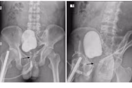 Mất khả năng cương dương sau tai nạn, nam thanh niên phải làm thể hang nhân tạo