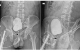 Mất khả năng cương dương sau tai nạn, nam thanh niên phải làm thể hang nhân tạo