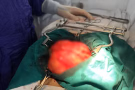 Một người ở Hà Nội mắc ung thư hiếm gặp, cắt bỏ 2 lần lại tái phát u “khủng”
