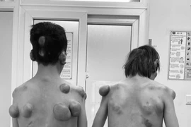 Hai anh em sinh đôi mắc căn bệnh hiếm gặp, khắp người mọc hàng trăm khối u lớn nhỏ