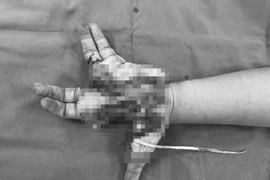 Bé trai 14 tuổi bị dập nát bàn tay do điện thoại phát nổ khi đang sử dụng
