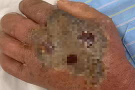 Vào “mùa rắn cắn”, một trường hợp hoại tử bàn tay do tự điều trị